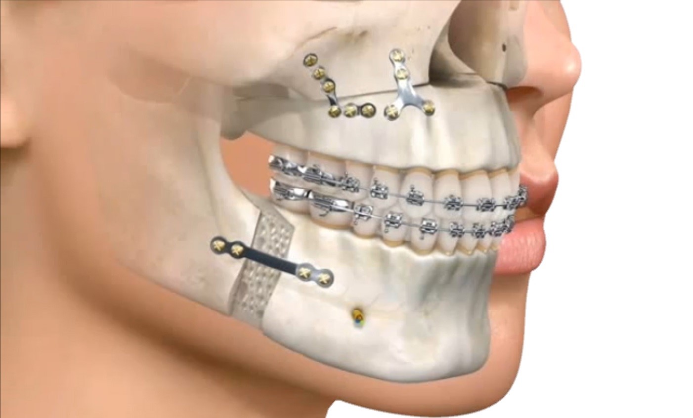 Все о прикусе зубов человека: виды, лечение, причины и последствия и как исправить неправильный прикус